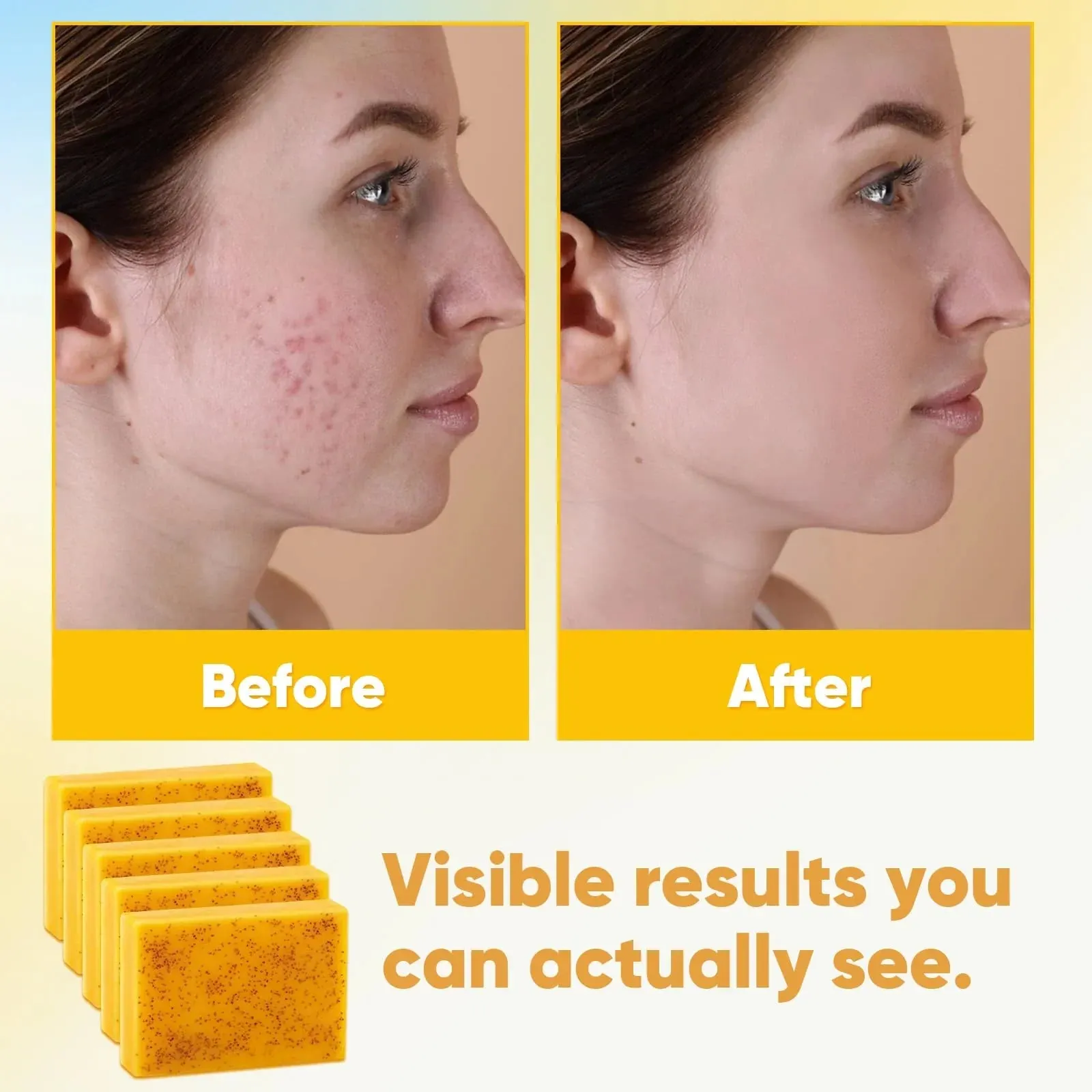 Turmeric & Kojic Acid Soap 5-Pack
